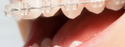 aparelho-ortodontico-3